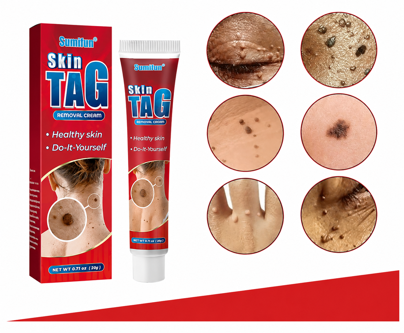 Skin Tag Removal Cream